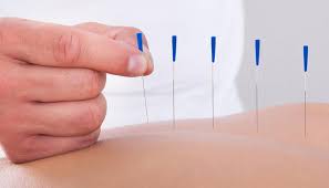 acupunctuur en afvallen